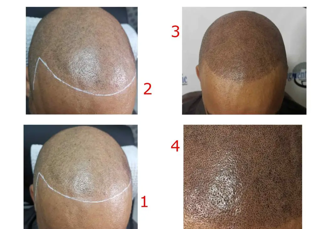 hairline tattoo before and after1