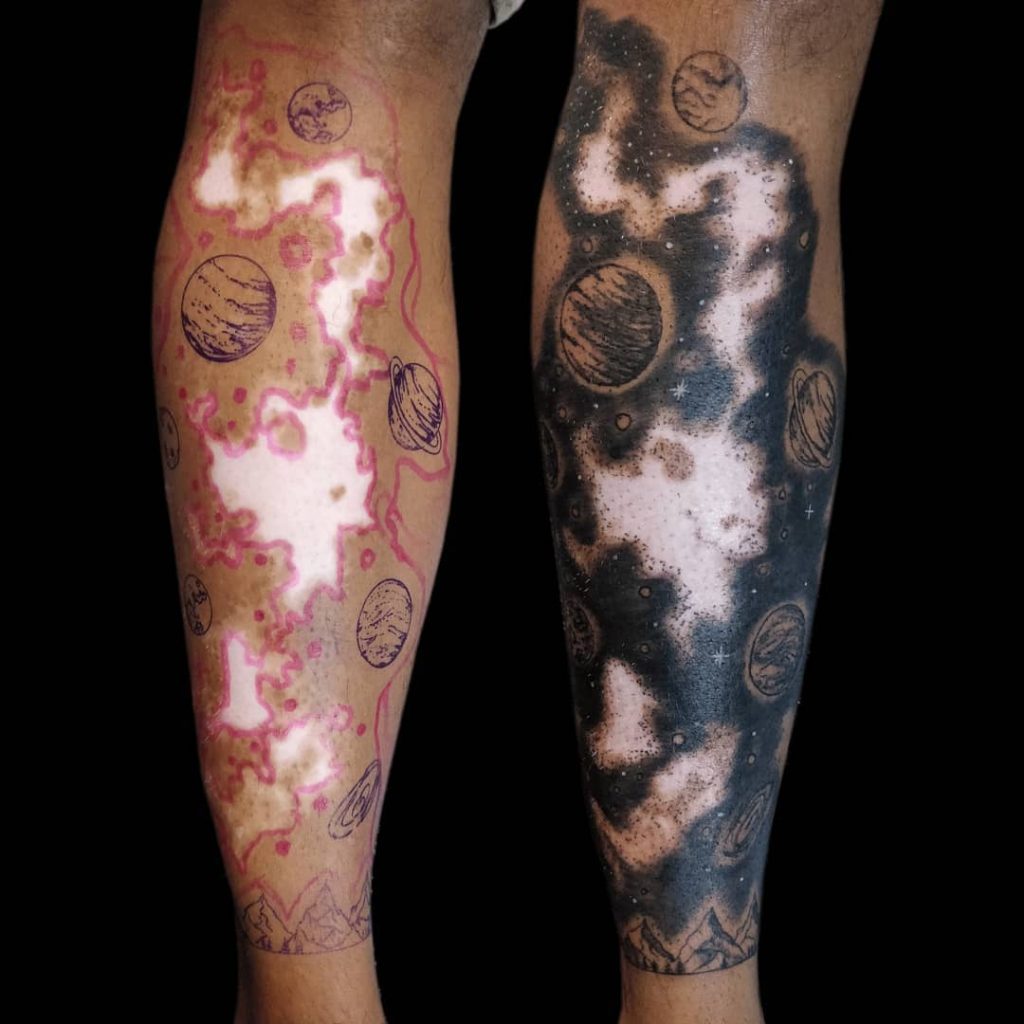 Does Vitiligo Affect Tattoos