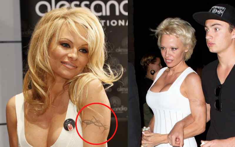 Pamela Anderson Tattoo Removal
