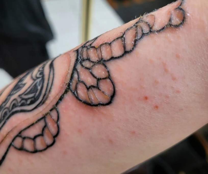 Bumps On an Old Tattoo