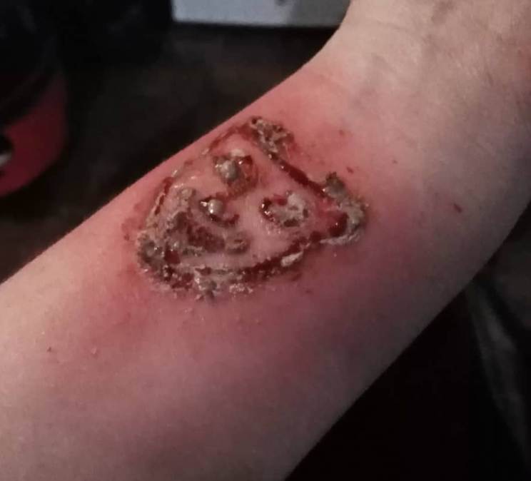 Signs of tattoo infection