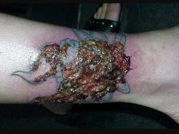 Tattoo Infection Causes